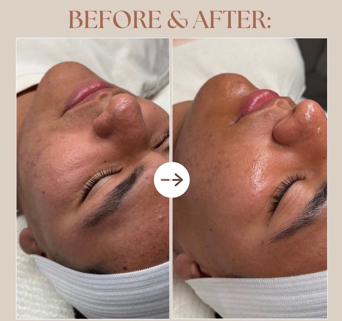 Client before and after facial treatment